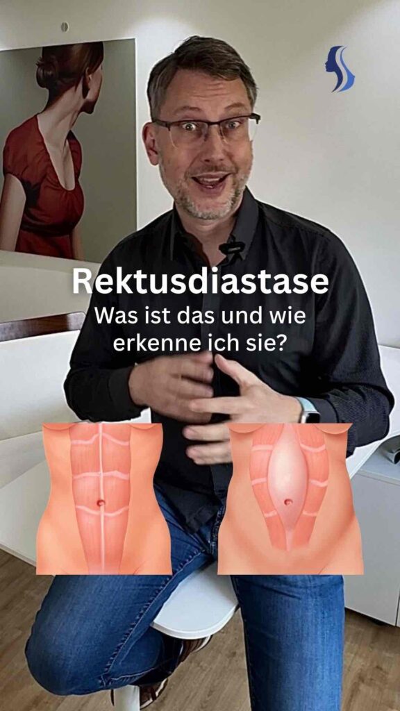Rektusdiastase - was ist das und wie erkenne ich sie?
